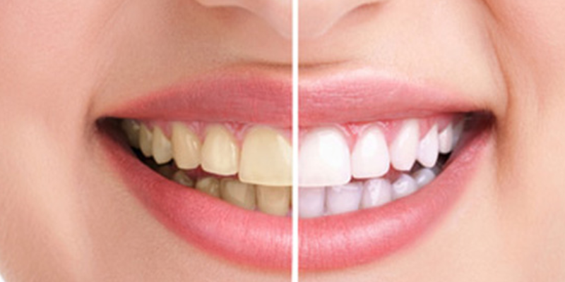 Sau sinh bao lâu thì bọc răng sứ được