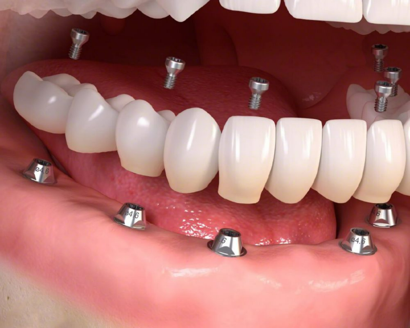 Trồng răng Implant vĩnh viễn có tốt không? Loại trụ Implant nào tốt nhất? Chi phí trồng răng Implant là bao nhiêu? 6 Trồng răng Implant vĩnh viễn