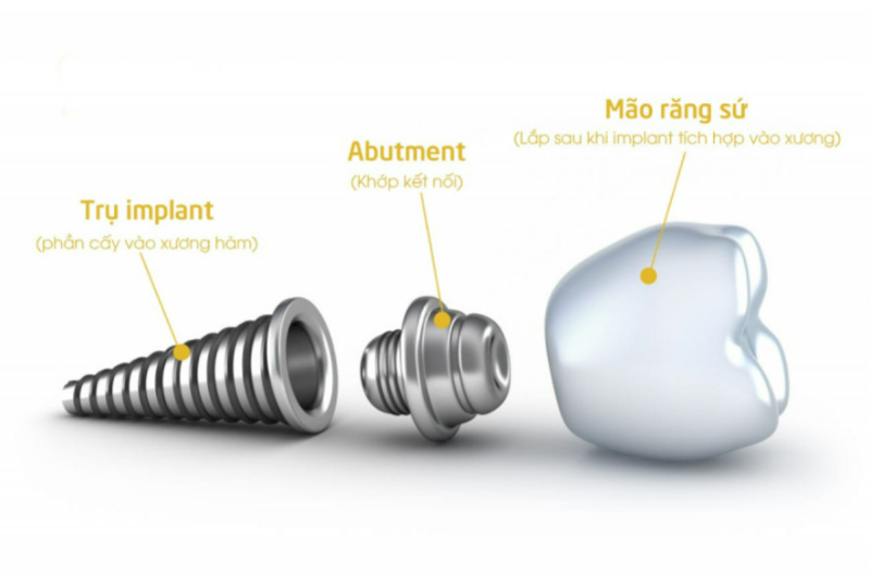 Trồng răng Implant vĩnh viễn có tốt không? Loại trụ Implant nào tốt nhất? Chi phí trồng răng Implant là bao nhiêu? 9 Trụ Straumann Thụy Sĩ