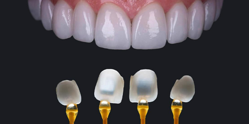 Sứ Veneer Emax Cao Cấp
