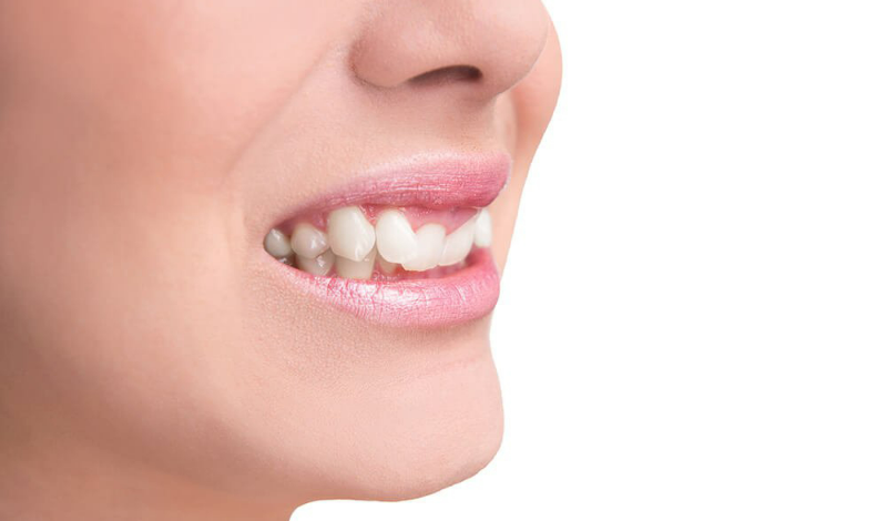 Phương pháp niềng răng khắc phục khớp cắn sâu hiệu quả