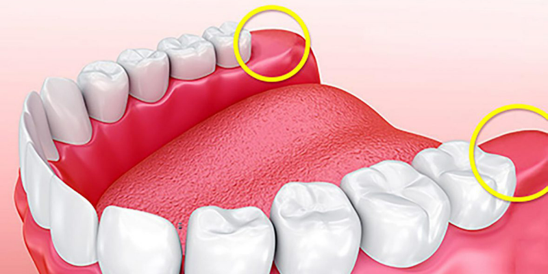 Lưu ý trước khi nhổ răng khôn