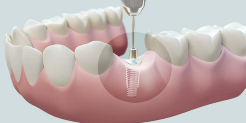 Trồng răng Implant