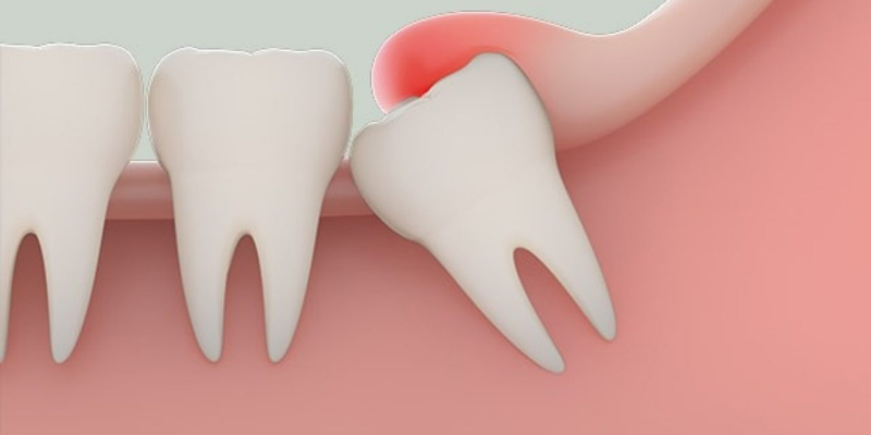 Lưu ý sau khi nhổ răng khôn thường gặp tình trạng