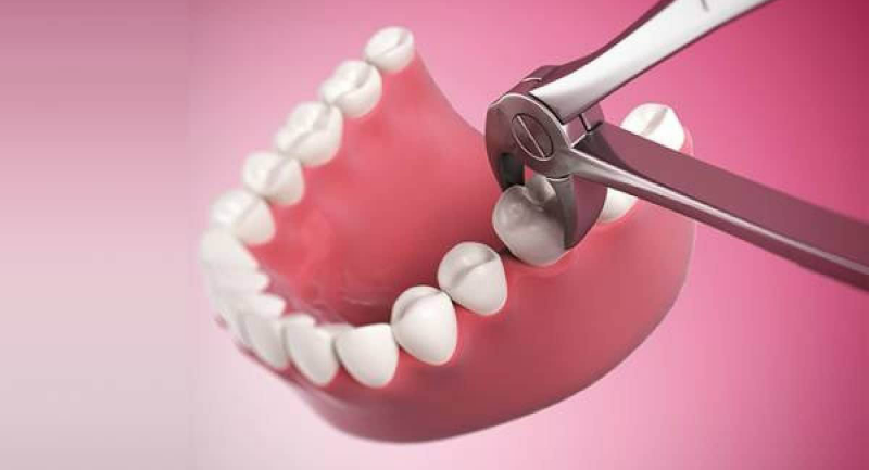 Nhổ răng nào nguy hiểm nhất? Quy trình nhổ răng tại nha khoa Singae uy tín 6 Quy trình nhổ răng tại Singae