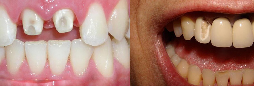 Tình trạng răng sứ bị hở chân để lâu không can thiệp sẽ có nguy cơ mất răng thật