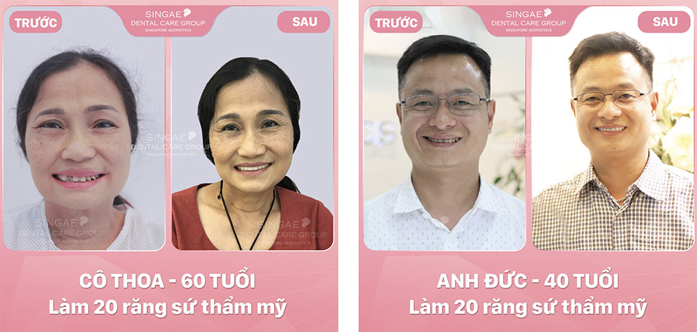Khách hàng của Singae không chỉ có kết quả tốt về thẩm mỹ sau khi bọc sứ, mà còn giữ được độ bền lâu dài 