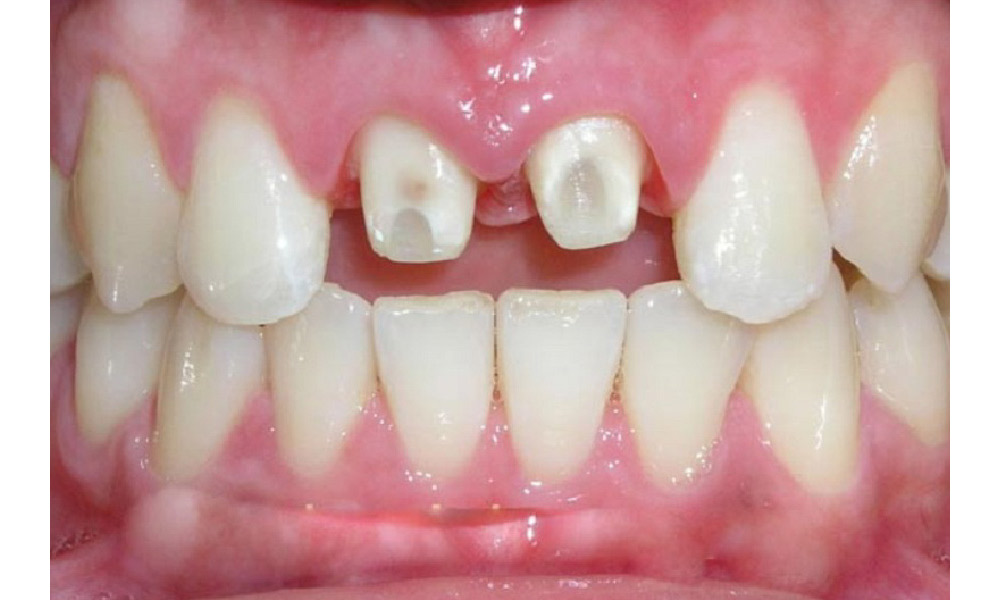 Sử dụng răng sứ kém chất lượng dẫn đến xuất hiện các dấu hiệu răng sứ bị hở chỉ sau thời gian ngắn