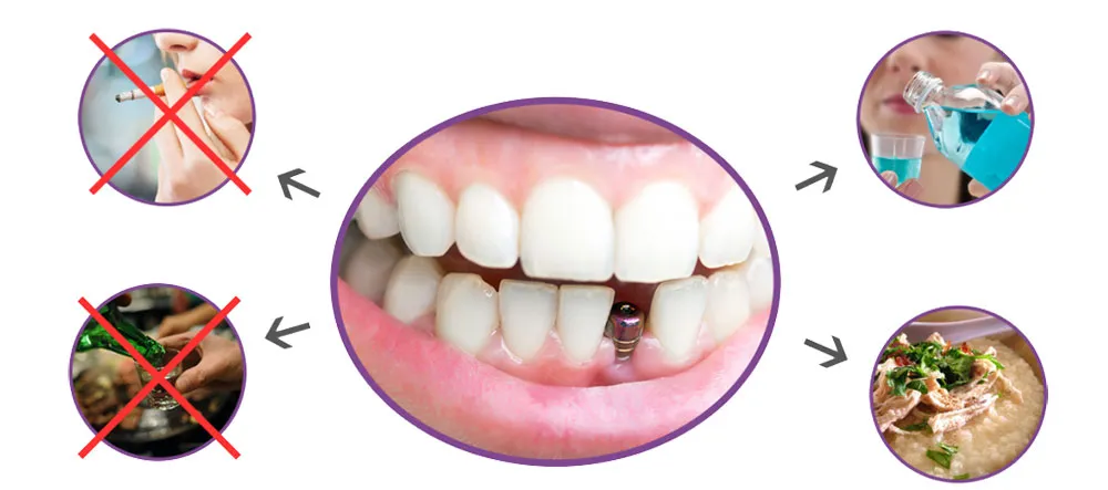 Biện pháp giảm đau sau khi trồng răng Implant