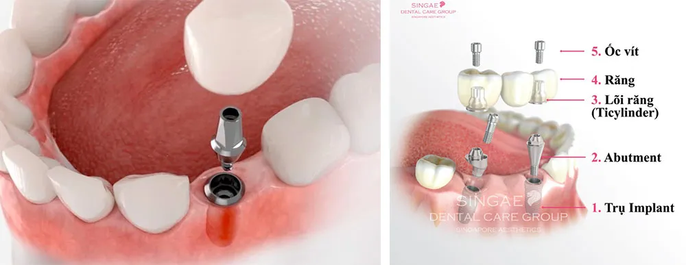 Yếu tố quyết định trồng răng Implant có đau không
