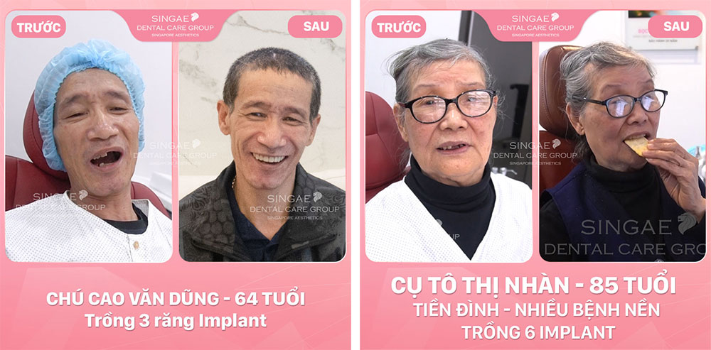 chi phí trồng răng giả implant