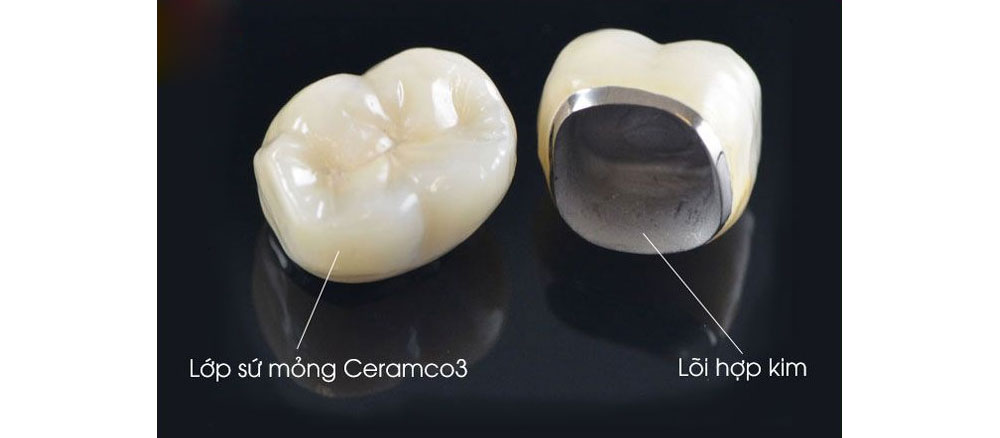 chi phí làm 1 răng implant