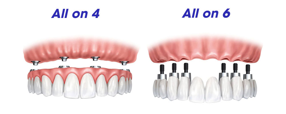 Tổng chi phí trồng implant cho cả hàm bao nhiêu?
