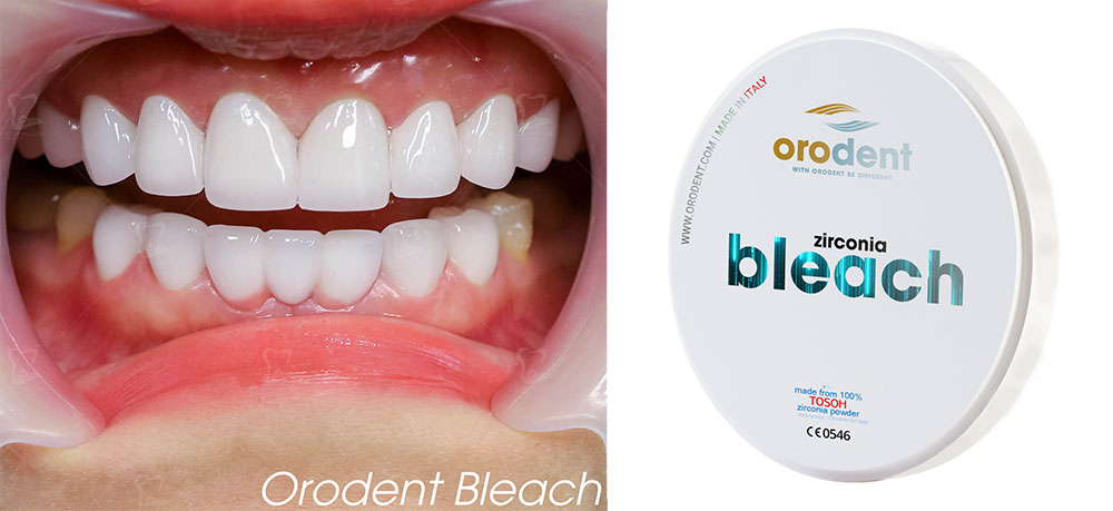 Bọc răng sứ Orodent mang lại tính thẩm mỹ cao