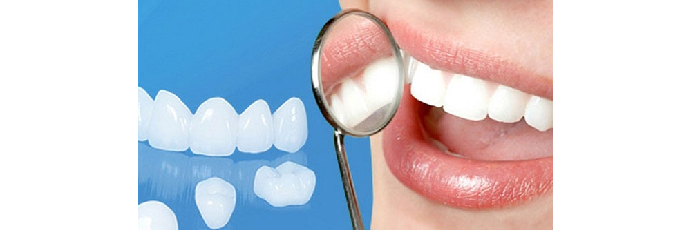 Tư vấn cách chọn răng sứ Orodent 