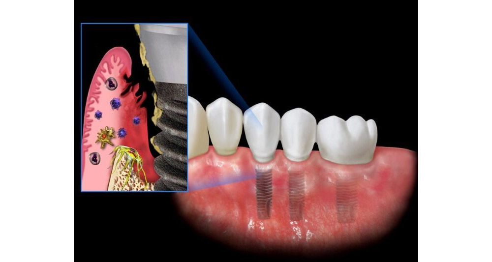 Viêm nhiễm là một trong những tác hại của việc cấy ghép Implant không đảm bảo