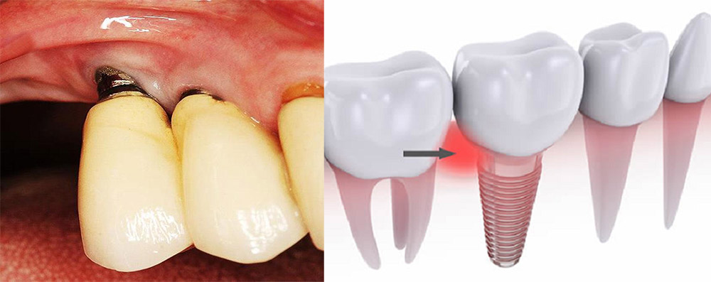 tác hại của việc trồng răng implant