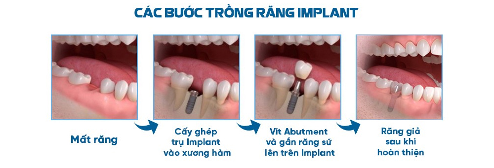 tác hại của việc trồng răng implant