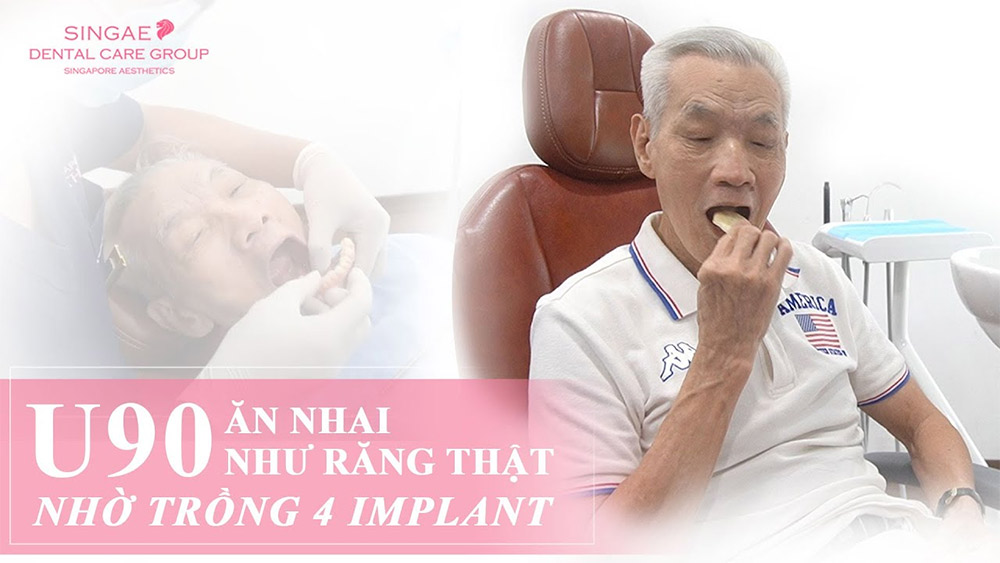 trồng răng cửa
