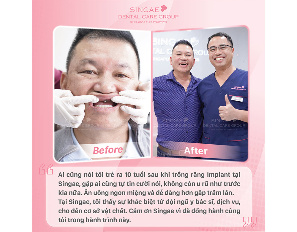 Trồng răng sứ răng cửa, giúp mọi người lấy lại tự tin khi giao tiếp