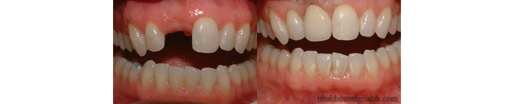 trồng răng cửa