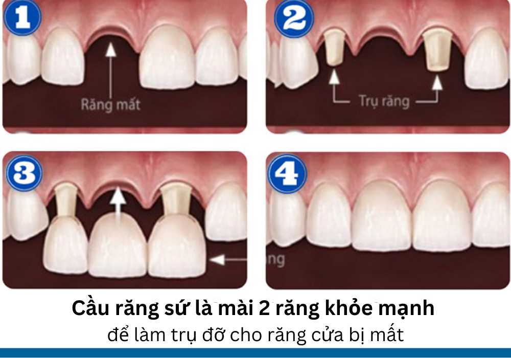 Trồng răng cửa bằng phương pháp bắc cầu 