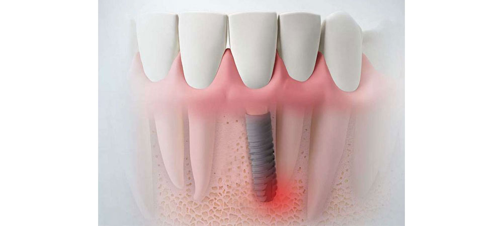 Trồng răng implant giá rẻ nhất là mấy 1 trụ? Chớ ham rẻ! 12 Trồng răng implant giá rẻ