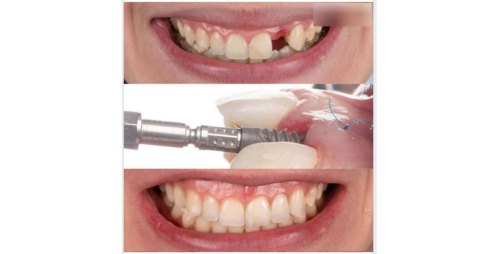 Trồng răng implant giá rẻ nhất là mấy 1 trụ? Chớ ham rẻ! 13 Trồng răng implant giá rẻ để lại nhiều rủi ro mà trước mặt bạn sẽ không thấy được