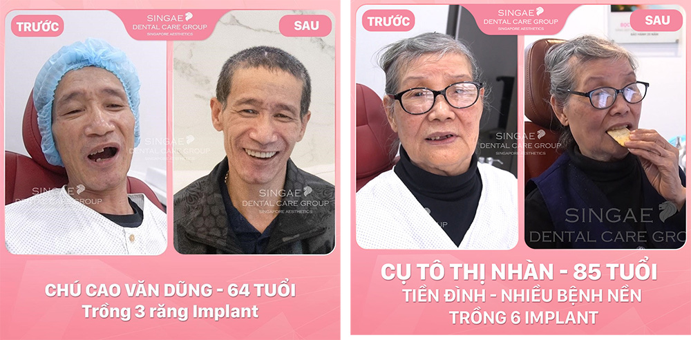 10 Địa chỉ trồng răng Implant ở đâu tốt TpHCM? 27 trong rang implant o dau tot tphcm 6