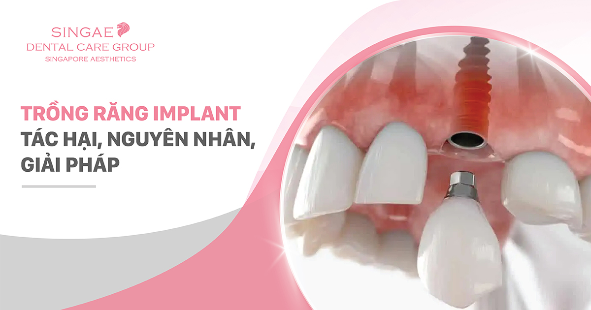 6 Tác hại của việc trồng răng Implant bạn nên biết