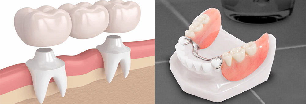mất răng số 7 hàm dưới