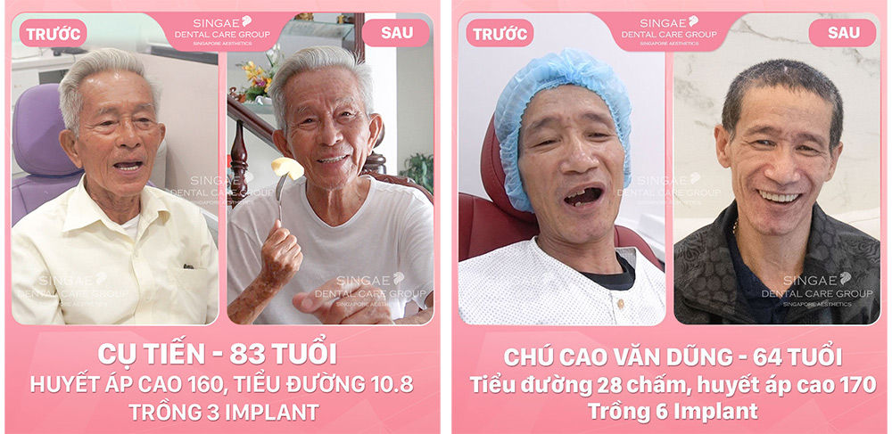 mất răng số 7 hàm dưới
