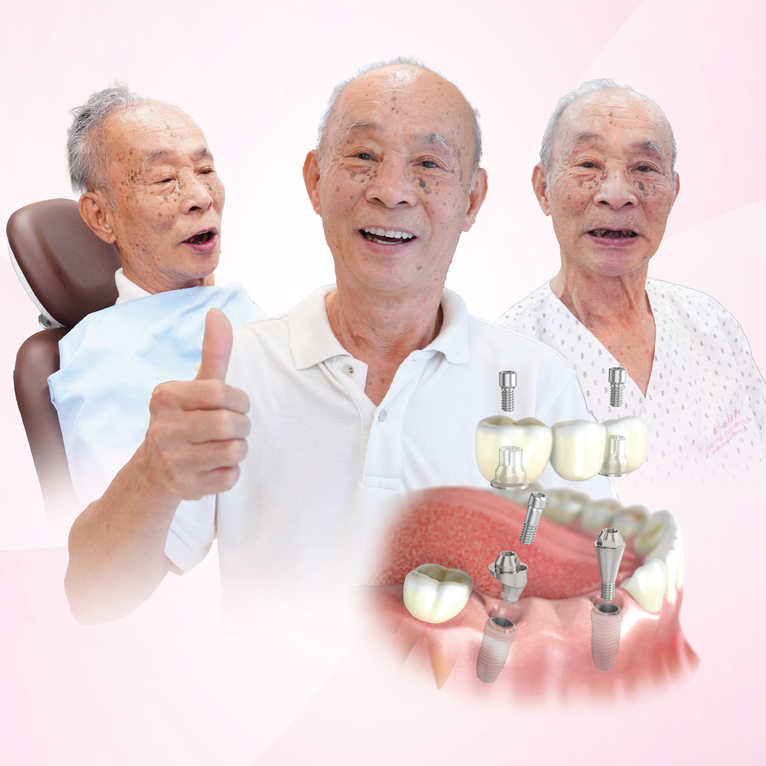 Trồng răng Implant