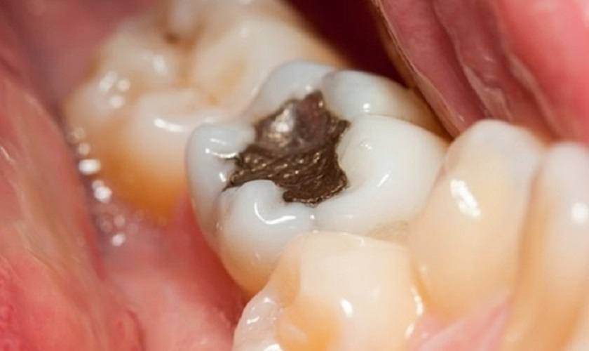 Tác hại của việc trám răng là gì ? 6 Điều bạn cần lưu ý ! 13 tác hại của việc trám răng