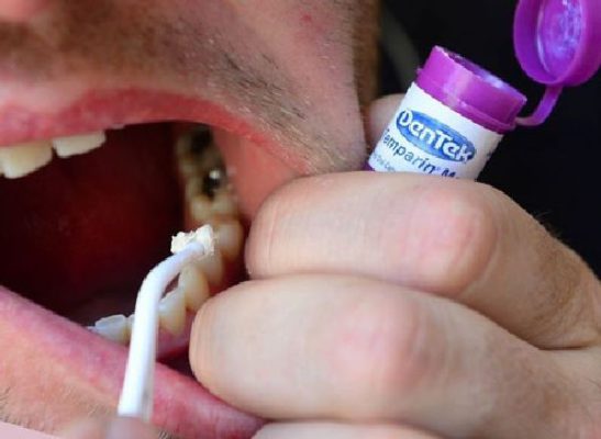 Tác hại của việc trám răng là gì ? 6 Điều bạn cần lưu ý ! 16 Không tự trám răng tại nhà