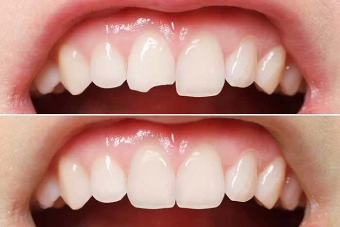 Trám răng bị mẻ