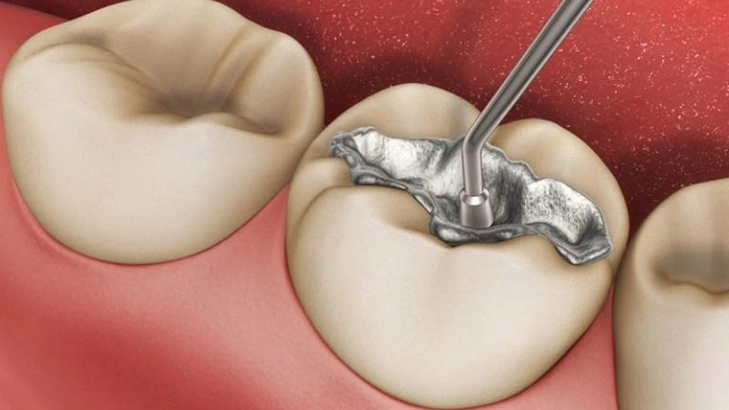 Tác hại của việc trám răng là gì ? 6 Điều bạn cần lưu ý !
