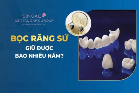 Bọc răng sứ bao lâu thì phải thay thế