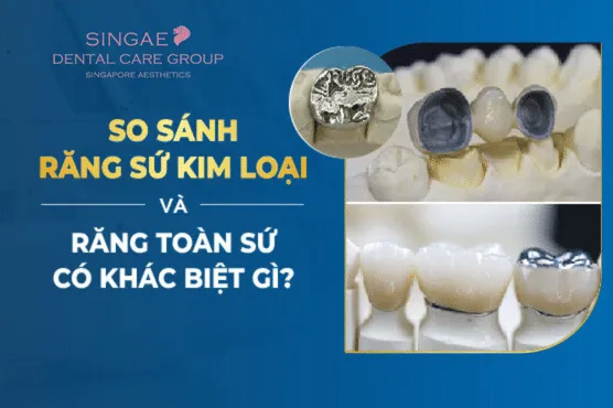 Các loại răng sứ