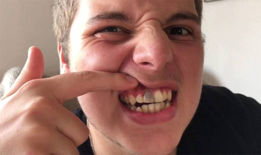 Sâu răng cửa là gì? Nguyên nhân và cách ngăn ngừa 9 Cách điều trị sâu răng cửa