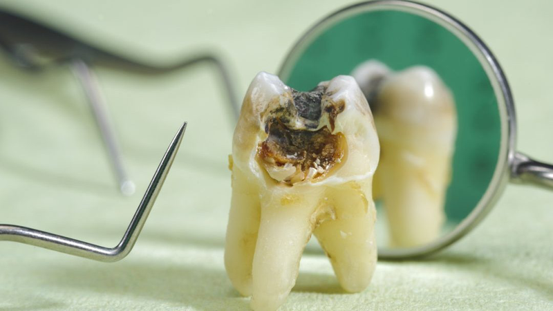 Cách trị sâu răng nặng