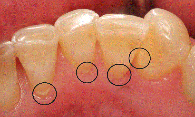 Cao răng là gì? Tại sao bạn phải lấy cao răng định kỳ?