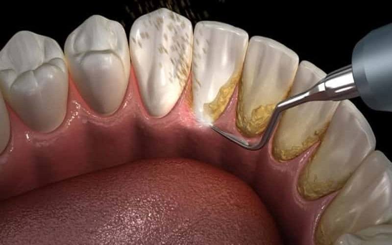 Cạo vôi răng là gì? 8 điều bạn nên biết khi lấy vôi răng 10 Cạo vôi răng có đau không