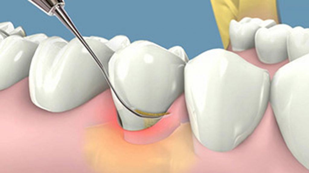 Cạo vôi răng là gì? 8 điều bạn nên biết khi lấy vôi răng
