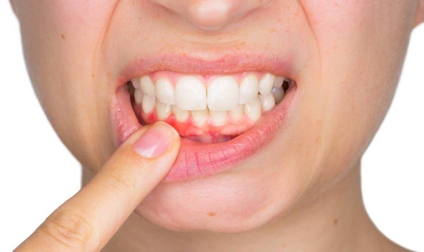 Cạo vôi răng là gì? 8 điều bạn nên biết khi lấy vôi răng 12 Có thể tự cạo vôi răng tại nhà được không
