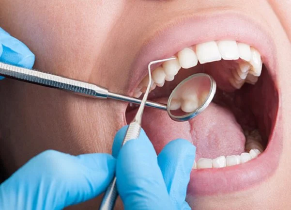 Cạo vôi răng là gì? 8 điều bạn nên biết khi lấy vôi răng 8 Đối tượng nên và không nên cạo vôi răng