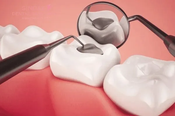 Hàn răng, trám răng là gì? Khi nào cần đi hàn răng và lưu ý