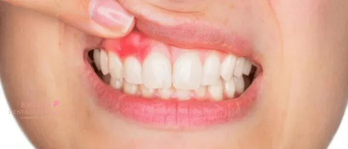 Hình ảnh viêm nướu răng : Dấu hiệu nhận biết và cách trị