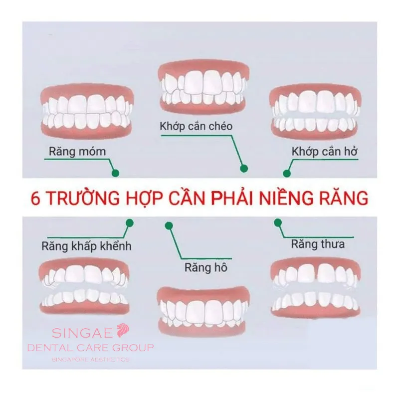 Khi nào nên niềng răng