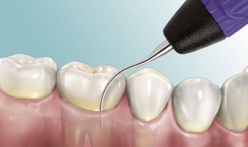 Lấy cao răng có đau không? Có ảnh hưởng gì đến răng không? 10 Lấy cao răng có ảnh hưởng gì không